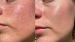 © Vikto - Close-up comparison of female cheek skin before and after care. Acne, redness, and blemishes reduced, showing clear and smooth result. Dermatology, skincare, beauty treatment.