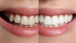 © Sarvana - Dental concept before and after treatment with braces showing teeth correction