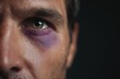 © Xenia_Stash - An extreme close-up on a man's eye showing a severe purple and yellow bruise underneath it against a dark background.