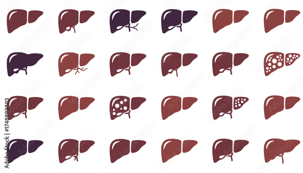 Liver vector icon set showing healthy, fatty, and cirrhosis liver ...