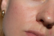 © Vikto - Macro of real facial skin texture with pores and redness. Close-up showing imperfect skin condition, ideal for dermatology, skincare, cosmetic industry or medical usage.