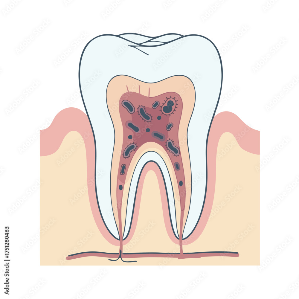 Tooth Cross-Section Illustration with Decay, Showing Enamel, Dentin ...
