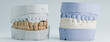 © Maximusdn - Dental plaster jaw models for orthodontic analysis