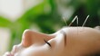 © ittipol - Relaxing acupuncture session for wellness and balance.