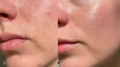 © Vikto - Macro close-up of female face showing before and after skincare results with visible pores, acne, and redness transforming into smooth glowing healthy skin. Perfect for beauty and dermatology themes.