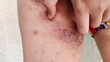 © Rung Kh - close up of a teenage patient, rash and hives, inflammation and allergic, reaction and scratch, symptom and allergy on the body, health care and medical concept.