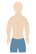 © Gebbi Mur - Enlarged lymph nodes. Color vector illustration. The patient has swollen lymph nodes in the neck and armpits. A symptom of problems in the body. Isolated background. Flat style. Medical theme.