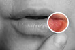 © olga_sova - Close up shows a painful lesion on the lip caused by the herpes simplex virus. Treatment focuses on alleviating symptoms and strengthening the immune system to prevent recurrence.