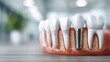 © Olena - Close-up of titanium dental implant embedded in jaw bone with gum tissue and adjacent teeth on a tabletop against a blurred clinic interior, anatomical model in foreground, concept of implantology edu