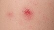 © vxnaghiyev - Skin inflammation caused by allergic reactions and pimples. Medical insights on red rashes and body care.