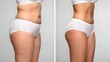 © Harmony of Forms - Before and after body transformation – dramatic difference after buttock firming treatment