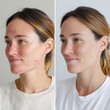 © tbralnina - Skin transformation before and after treatment showcasing improvement in complexion clarity