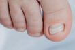 © Parilov - Close-up of human toes with natural nails on light background, problematic ingrown toenail