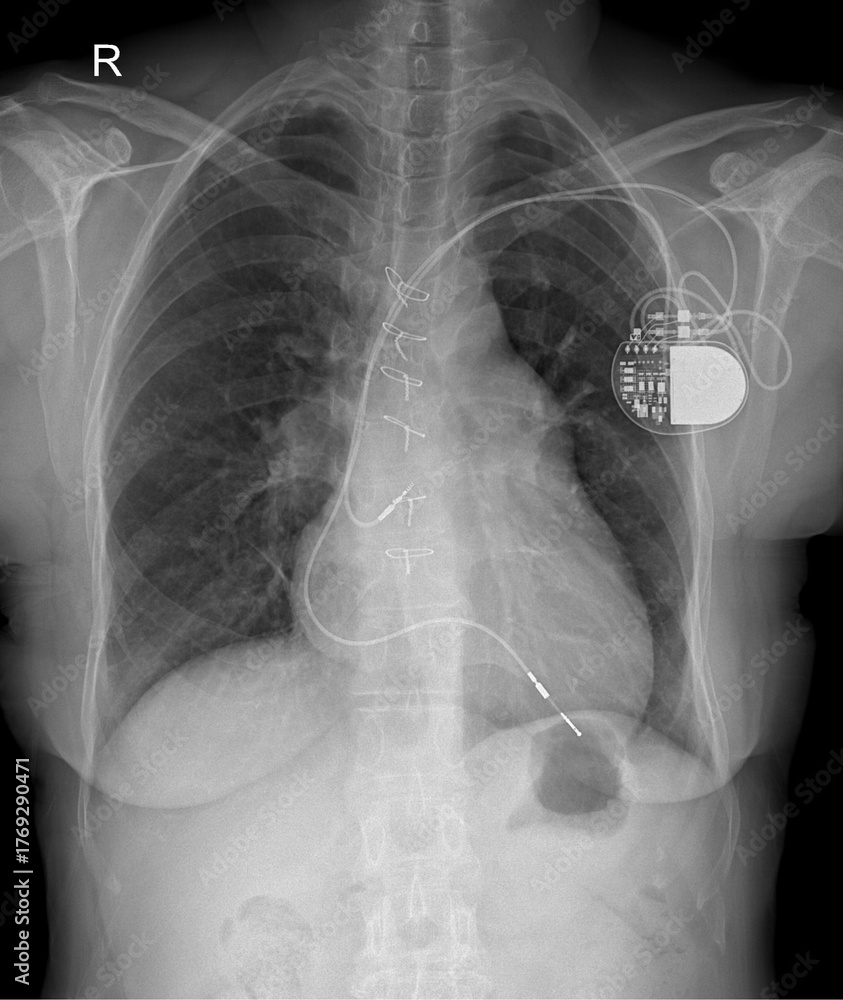 Pacemaker In Chest Foto de Stock Chest Radiograph Showing Implanted Pacemaker Cardiac ...