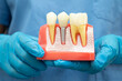 © kanruthai - Teeth root dental model with tool for dentist use to cleaning care treatment.