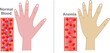 © LuckySoul - Anemia,  red blood cells or a decrease in the amount of hemoglobin in the blood. different skin colors on hand. Section showing normal and anemia blood contents in vessels. Vector illustration