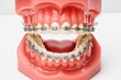 © Ahad - Orthodontic teeth model with metal braces for dental care and teeth alignment