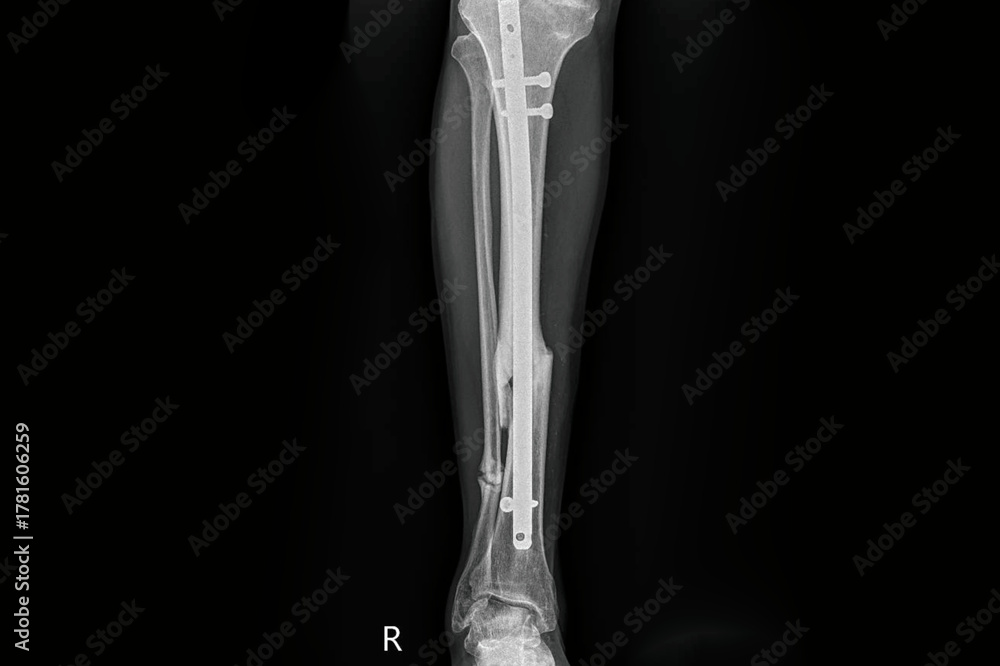 Leg X ray Radiograph Showing Tibia And Fibula Fracture With