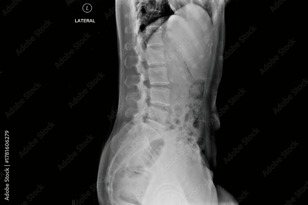 Стокове фото Lateral lumbar spine X-ray radiograph showing lower back ...