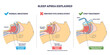 © VectorMine - Normal breathing overview shows airflow, tongue and soft palate shape open vs blocked airway, transparent background.CPAP holds airway open.Key objects, airway, tongue, nasal mask.