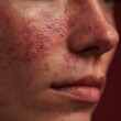 © rinrada - Skin with minor acne inflammation, visible redness and uneven skin tone.