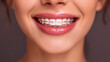 © kora studio - close up of woman mouth  with braces smiling brightly, her dental transformation and confidence. Her lips are glossy, and her teeth are well aligned, ing positive attitude