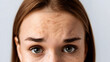 © Alesia - Close-up of a young Caucasian woman with brown hair and freckles. She has visible forehead lines and a concerned expression. Neutral background.