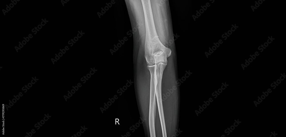 Lateral Humerus Rafiograf Elbow x-ray radiograph showing humerus, radius, ulna and joint. Lateral ...