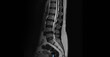 © Issara - MRI of lumbar spine showing vertebrae, intervertebral discs and spinal cord. Sagittal view magnetic resonance imaging for diagnostic examination of lower back and spine anatomy