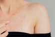 © Ольга Шефер - Close-up photo of young woman suffering acne in the chest and neck, showing her index finger on acne. Skin  diseases. Hormonal disorders.