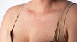 © HENADZY - Red pimples and rashes on the skin of a woman's chest, close-up, allergic reaction to medication, dermatology