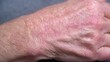 © JovialFox - Eczema close up skin: Close up photo of eczema affected area looking very itchy, inflamed, and causing discomfort to skin