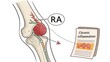 © mat - Illustration of a joint with rheumatoid arthritis and its effects