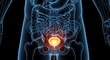 © Md - Anatomical illustration of the human urinary bladder with inflammation or infection