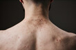 © Seventyfour - Back view of young adult man showing acne and skin blemishes on neck and upper back