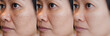 © Praewphan - cropped Image before and after spot melasma pigmentation treatment on skin face asian woman compare in 3 development periods. Skincare and beauty concept