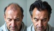 © Maryna - Man head shows baldness before hair loss treatment. After successful procedure, same person has thick healthy hair. Before, after comparison of hair regrowth solution for male health beauty results.