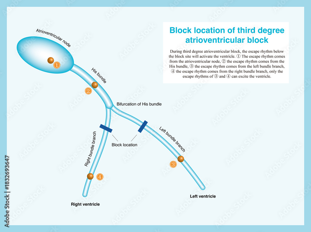 Stock-Illustration „Third degree atrioventricular block can occur in ...