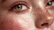 © Thiago - Close-up of a person's face showcasing detailed skin features, particularly the freckles around the nose and cheeks, highlighting the eyes
