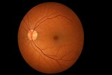 Fundus photograph of the human retina showing optic disc, macula, and blood vessels