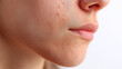 © Marut - Close up of young woman face with inflamed skin, small red bumps, acne, and visible pores, showing mild irritation and natural texture on cheek and chin area