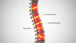 © Shahbaz - Anatomical illustration of a spine with highlighted areas of l4l5 disc herniation and cervical radiculopathy showing muscle stress