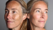 © Daniel - Before After anti aging face photo skin spa treatment older woman 40s 50s menopause wrinkles fine line saggy jowls afterwards smooth glowing younger firm microneedling rf therapy LED laser treatment