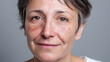 © Marut - Realistic portrait showing mild patchy texture across cheeks and natural wrinkles on middle aged woman with short hair smiling gently against gray background