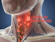 © Sharmin - Swollen lymph nodes in human neck anatomy