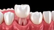 © Pannee - Detailed Illustration of Dental Crown Procedure with Teeth and Gums on Dark Background