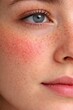 © Alamin - Close up portrait showing red skin on a cheek with freckles possibly rosacea or flushing