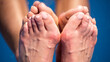 © Volodymyr - Hallux valgus deformity of big toe joint. Bare foot with Hallux valgus deformation. Human foot sole with deformities. Hallux Valgus on female legs close up. Feet of woman with hallux valgus.