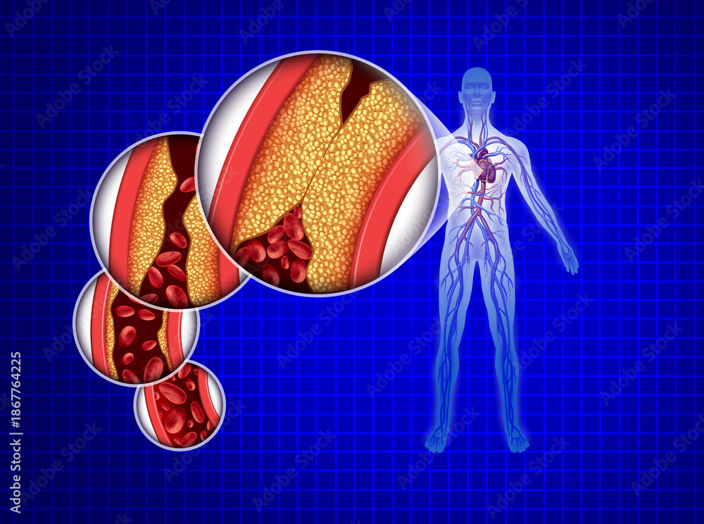 Inner Circulation Blocked Human Cardiovascular Circulation and atherosclerosis as a heart ...