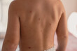 © nataliaderiabina - Little boy with chickenpox at home. Childhood rash. Little child with allergies, atopic dermatitis and chickenpox indoors. Close up of rashes on a child's skin - varicella zoster virus.